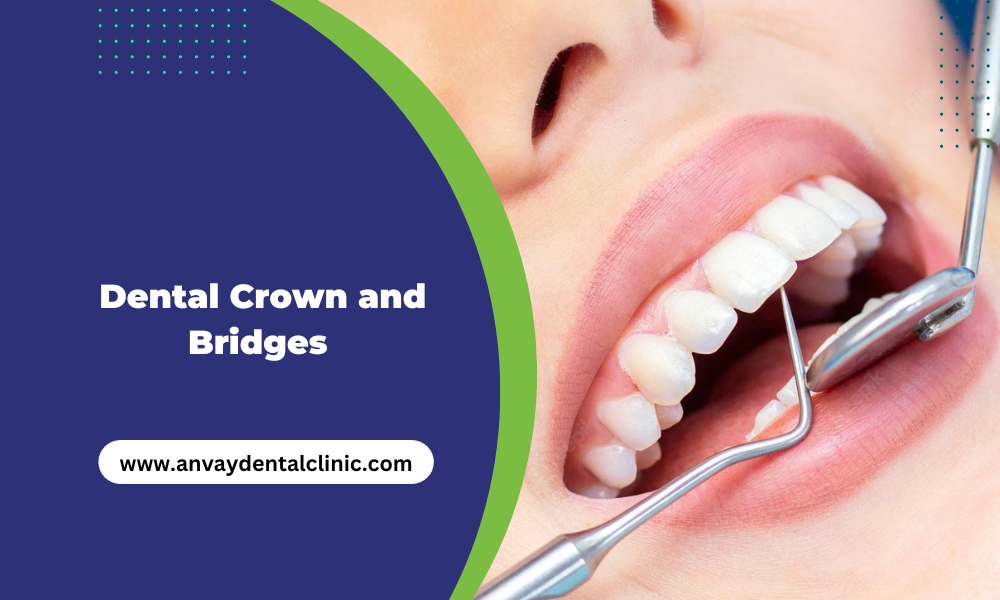 dental crown and bridge at anvay dental clinic memnagar ahmedabad