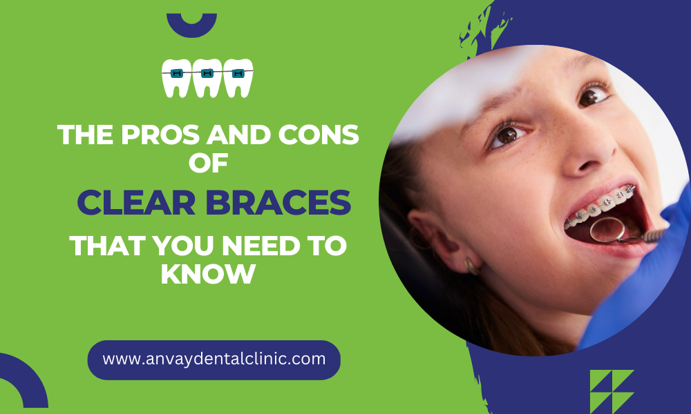 Pros and Cons of Clear Braces at anvay dental clinic memnagar ahmedabad